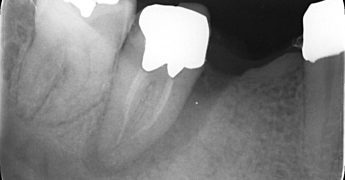 歯周 - 歯内病変の治療　山梨・あいざわ歯科クリニック