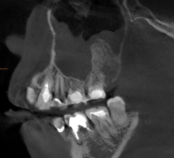 上顎骨嚢胞　術後　あいざわ歯科クリニック