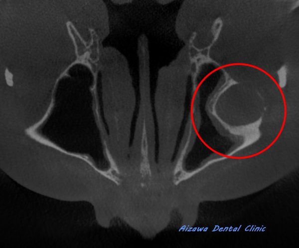 上顎骨嚢胞　あいざわ歯科クリニック