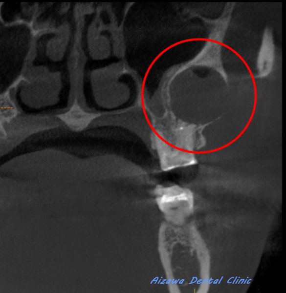 上顎骨嚢胞　あいざわ歯科クリニック
