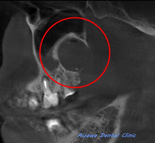 上顎骨嚢胞　あいざわ歯科クリニック