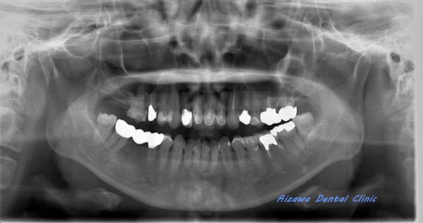 上顎骨嚢胞　あいざわ歯科クリニック