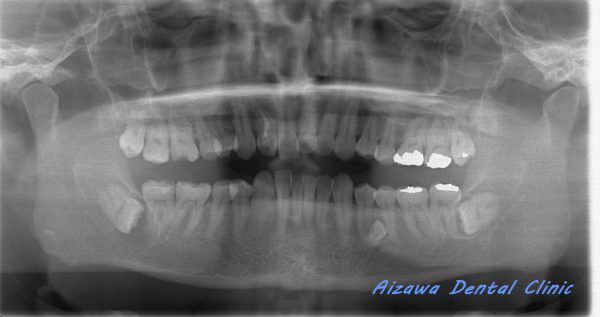 濾胞性歯嚢胞　あいざわ歯科クリニック　口腔外科