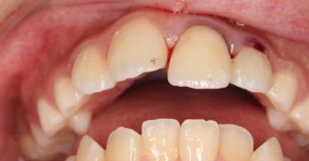 歯の脱臼・歯の外傷　 あいざわ歯科クリニック
