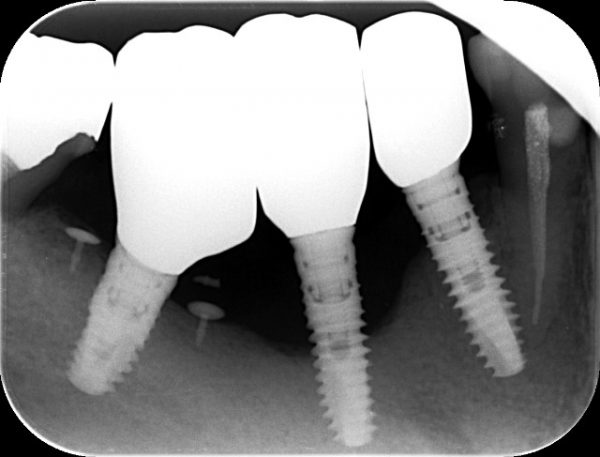 インプラント周囲炎　あいざわ歯科クリニック
