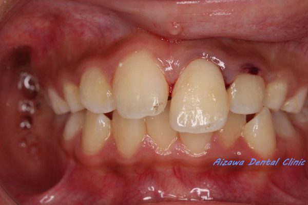 歯の脱臼・歯の外傷　 あいざわ歯科クリニック