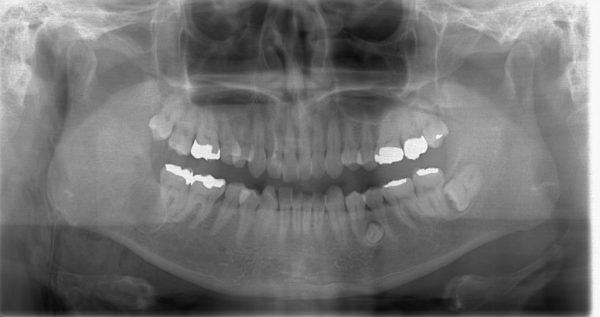 濾胞性歯嚢胞　あいざわ歯科クリニック　口腔外科