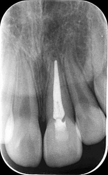 歯の脱臼・歯の外傷　術後　 あいざわ歯科クリニック