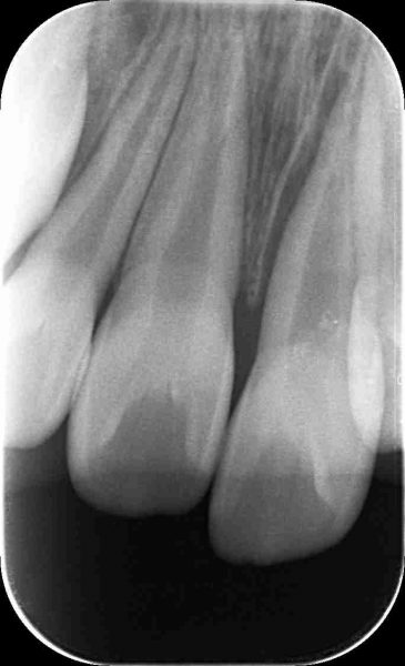 歯の脱臼・歯の外傷　 あいざわ歯科クリニック