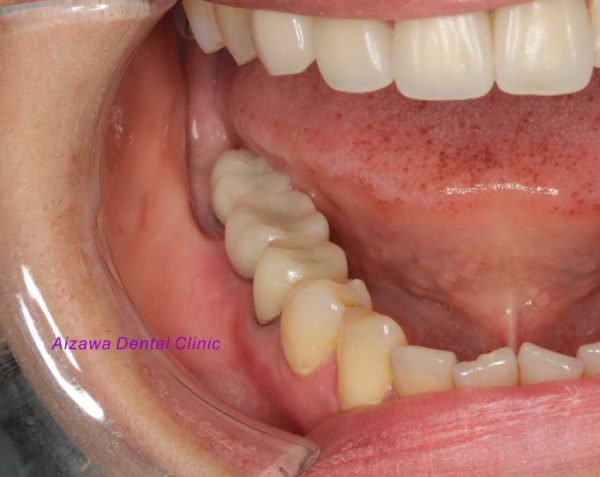 インプラント補綴　術後口腔内写真　あいざわ歯科クリニック