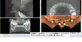 シンプラント　ビューワ　18.0