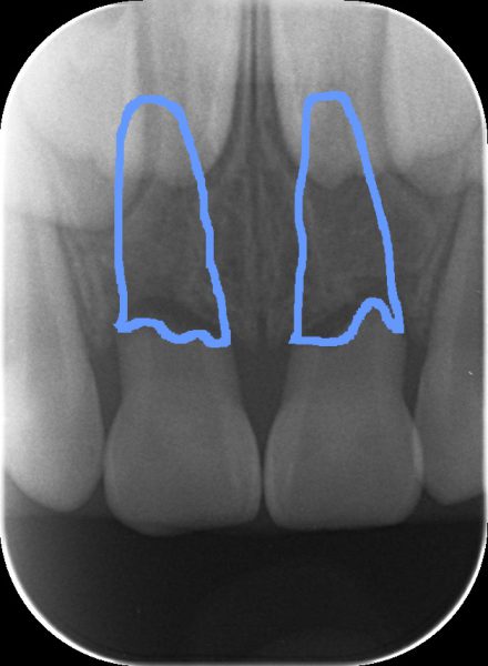 乳歯の外傷　あいざわ歯科クリニック
