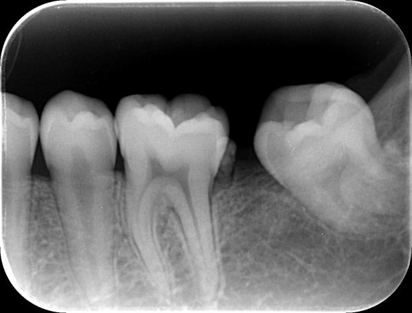 歯牙腫　摘出後　あいざわ歯科クリニック