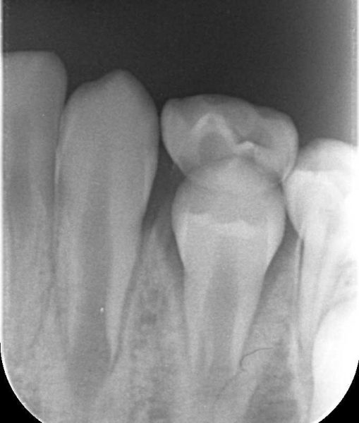 乳歯の抜歯　あいざわ歯科クリニック