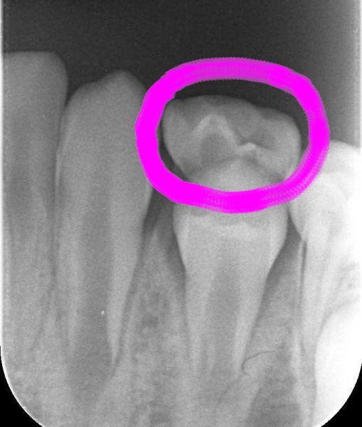 乳歯の抜歯　あいざわ歯科クリニック