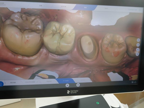 プライムスキャン　印象採得後　あいざわ歯科クリニック