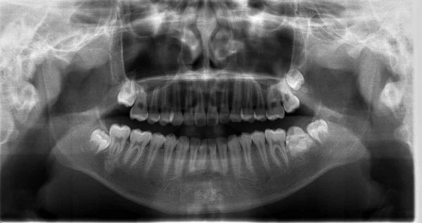 歯牙腫　あいざわ歯科クリニック