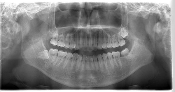 歯牙腫　摘出4年後　あいざわ歯科クリニック