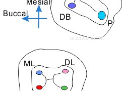 大臼歯の根管形態　あいざわ歯科クリニック