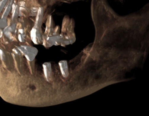垂直的骨造成　インプラント後　あいざわ歯科クリニック