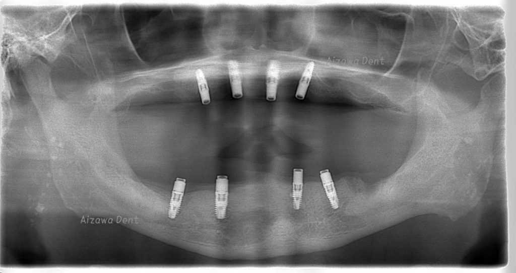インプラント義歯　ロケーターアバットメント　あいざわ歯科クリニック