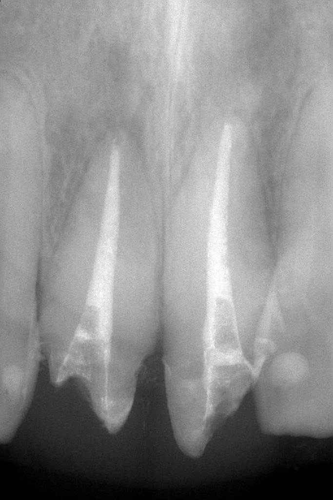 再根管治療　保険診療　あいざわ歯科クリニック