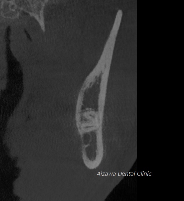 下顎管に近接する水平埋伏智歯　あいざわ歯科クリニック