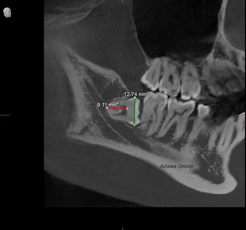 下顎管に近接する神経の名称　あいざわ歯科クリニック