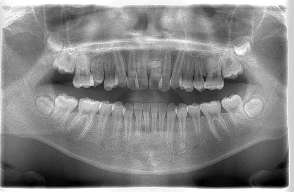 上顎正中過剰歯210911_矯正前　あいざわ歯科クリニック