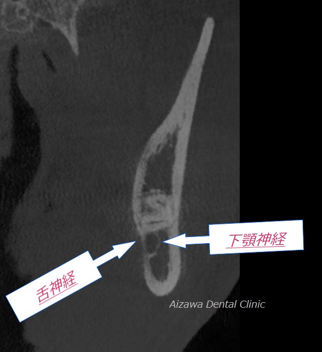 下顎管に近接する神経の名称　あいざわ歯科クリニック