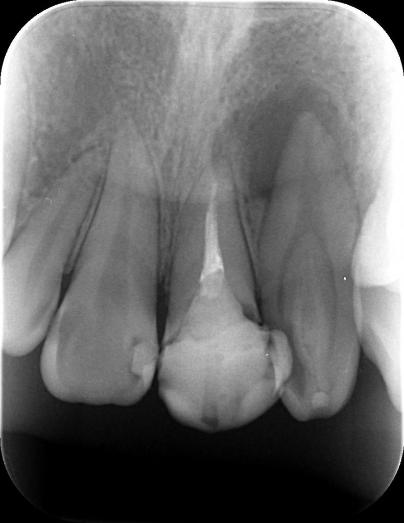 歯内歯　あいざわ歯科クリニック