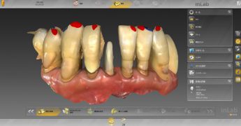 口腔内スキャナーIOS　あいざわ歯科クリニック