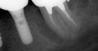 歯根破折X線　あいざわ歯科クリニック