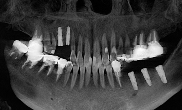 上顎のインプラント　あいざわ歯科クリニック