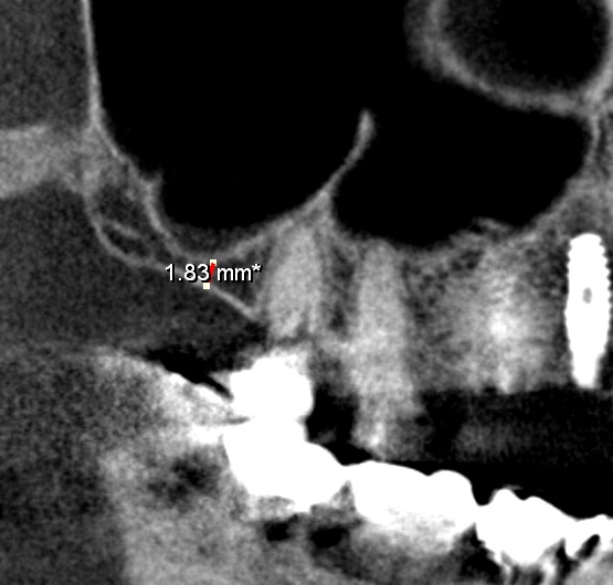 上顎のインプラント　あいざわ歯科クリニック