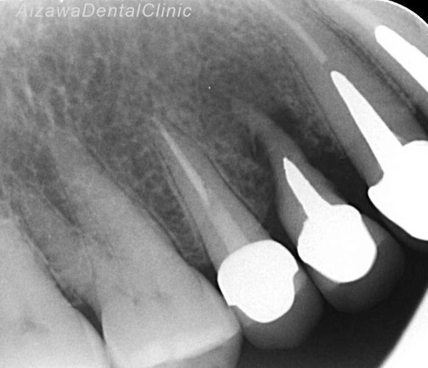 歯根部の吸収　あいざわ歯科クリニック