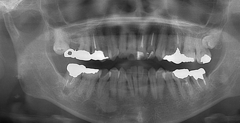 根尖病巣からの排膿　あいざわ歯科クリニック