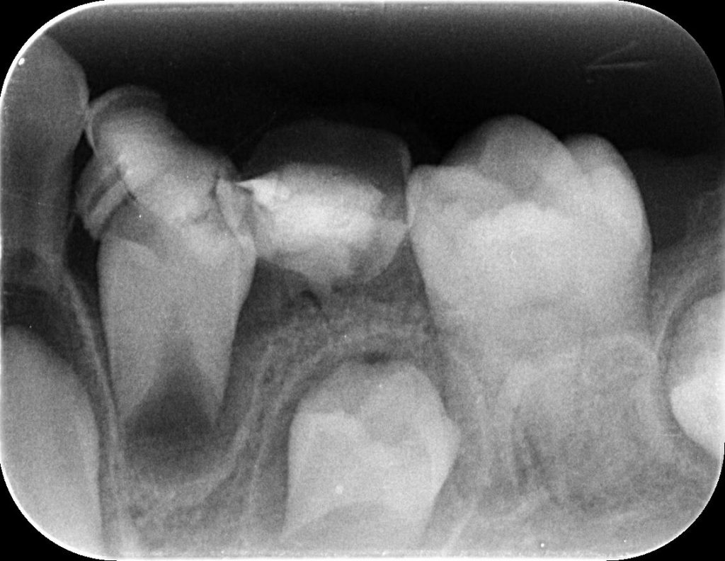 乳歯は適切な時期に抜歯しないといけません　あいざわ歯科クリニック