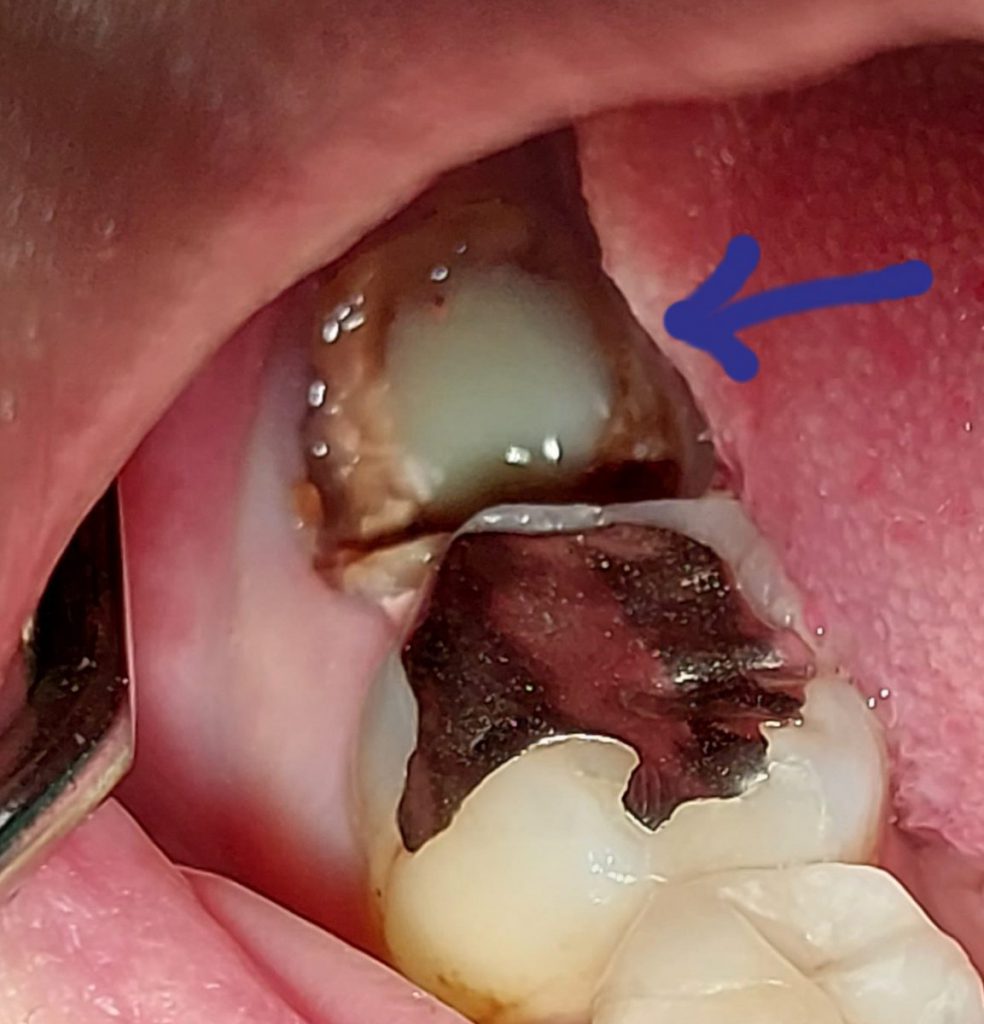 根管からの排膿　あいざわ歯科クリニック