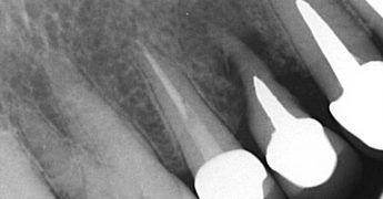 歯根の異常吸収　あいざわ歯科クリニック