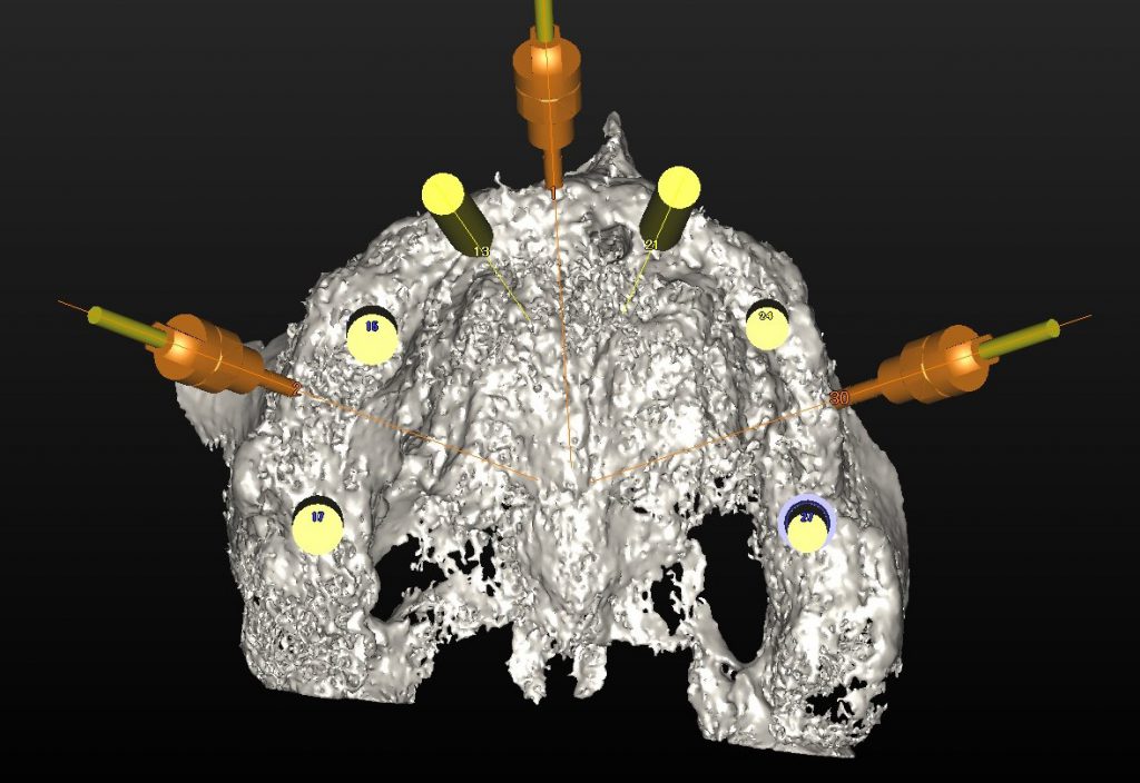 上顎骨フルマウス　ボーンアンカードブリッジ　あいざわ歯科クリニック