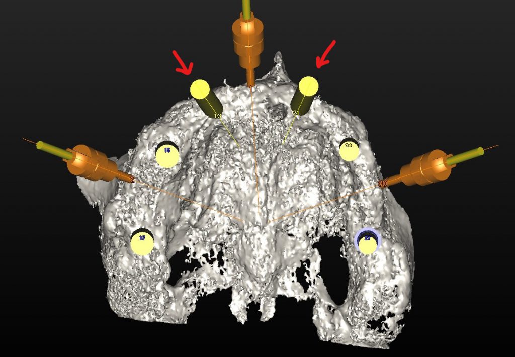 上顎骨フルマウス　ボーンアンカードブリッジ　あいざわ歯科クリニック