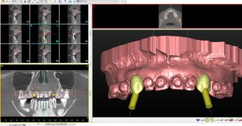 矯正治療中のガイデットサージェリー操作画面　あいざわ歯科クリニック