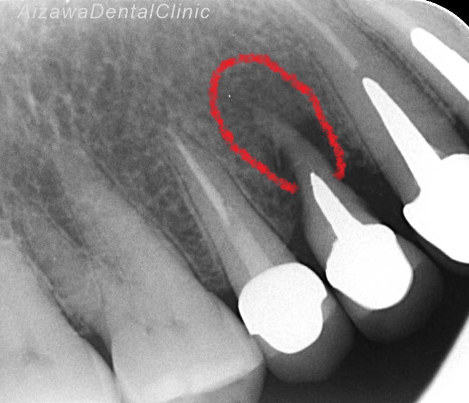 赤で囲まれた部分が歯根が吸収した場所です