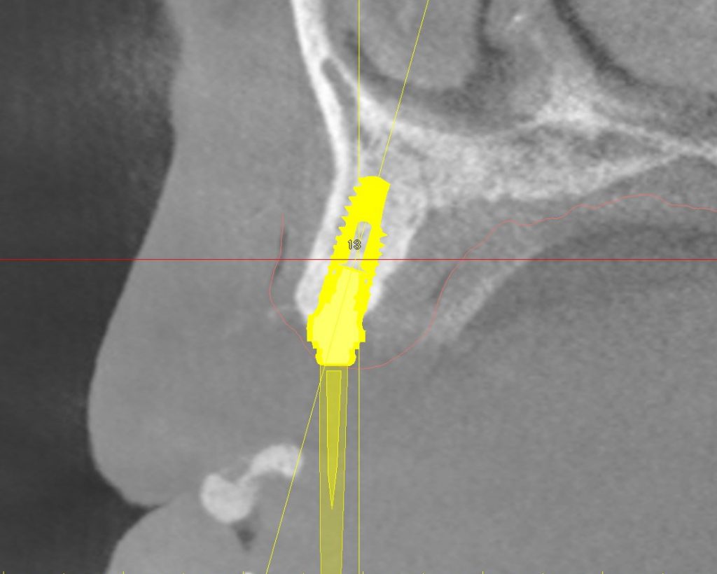 Xive MP Angled　Abutment