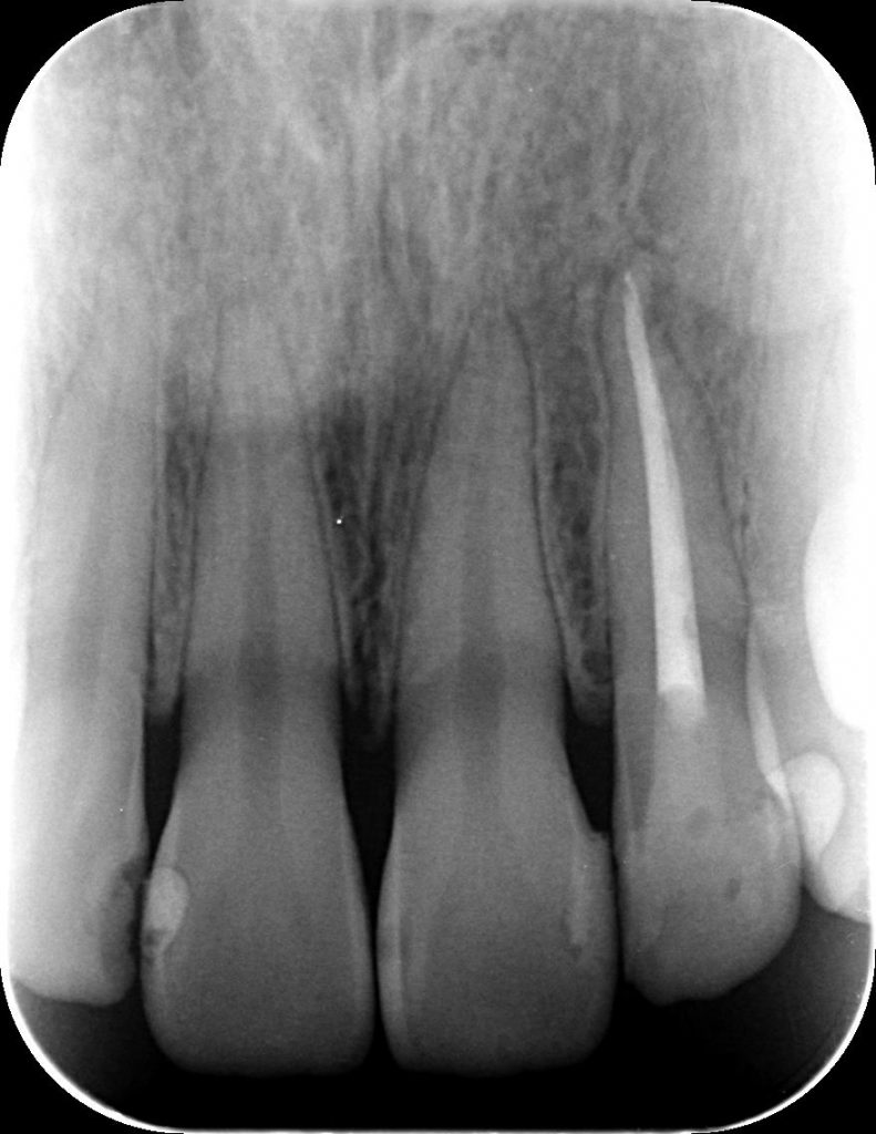 根管充填後の歯槽骨の再生　あいざわ歯科クリニック