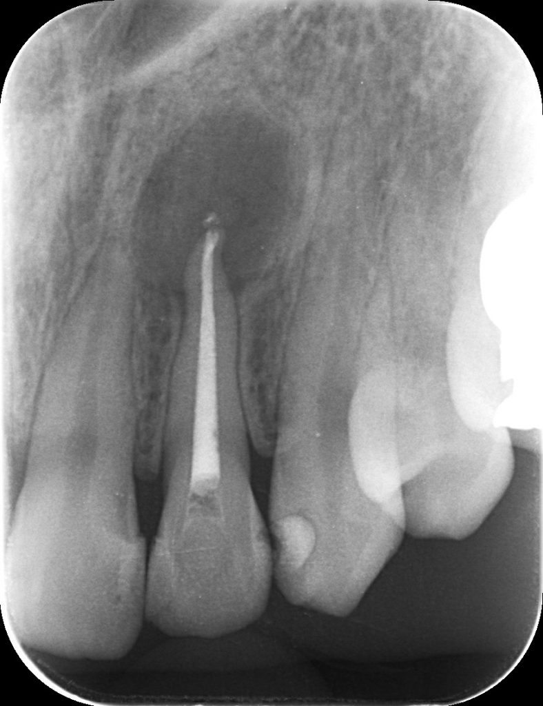MTA　根管充填後　あいざわ歯科クリニック