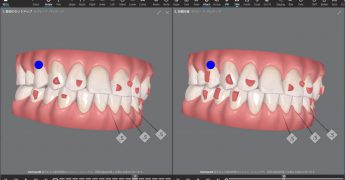 インビザライン治療比較　あいざわ歯科クリニック