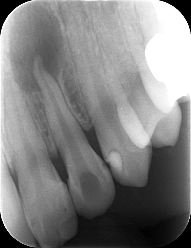 根尖部病巣　あいざわ歯科クリニック