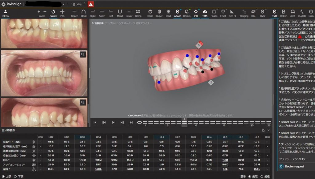 クリンチェック　歯牙移動量　あいざわ歯科クリニック